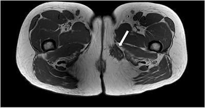 Case Report: Extrapelvic Endometriosis in the Medial Thigh